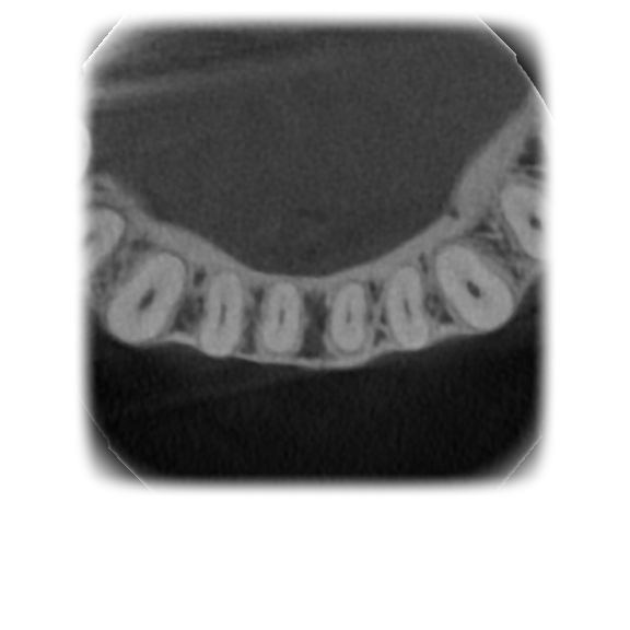 Original axial CBCT slice through the anterior teeth